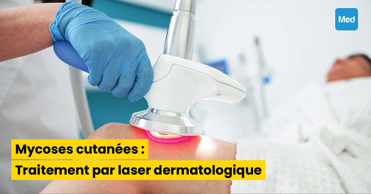 Mycoses cutanées : Traitement par laser dermatologique